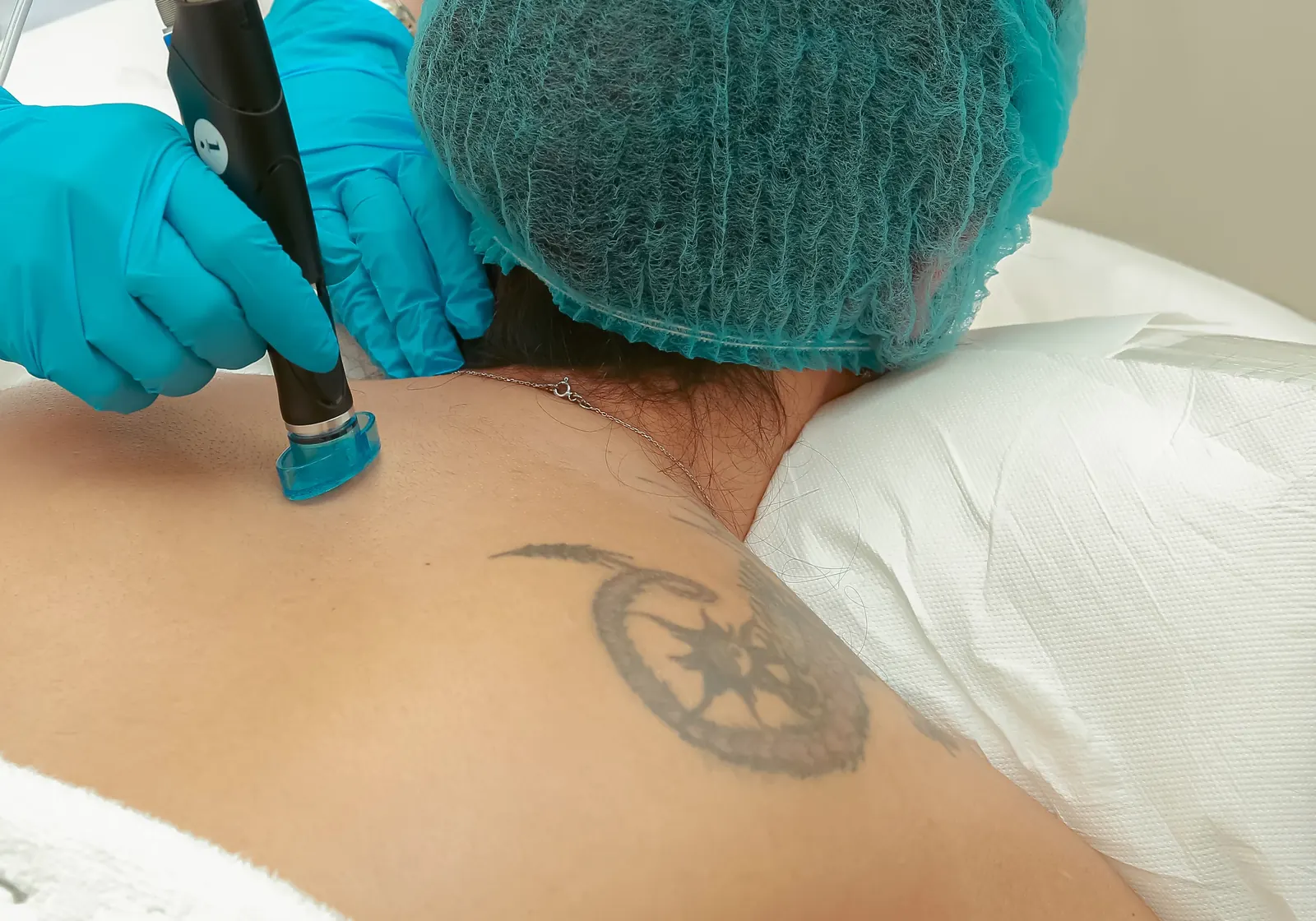 Pieza de mano de un láser sobre un tatuaje en la espalda